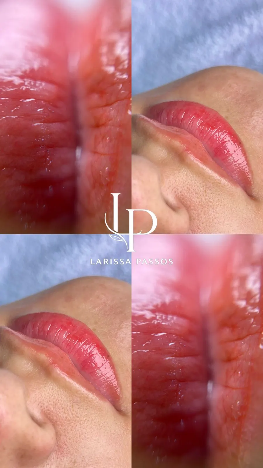Antes e depois de um procedimento labial